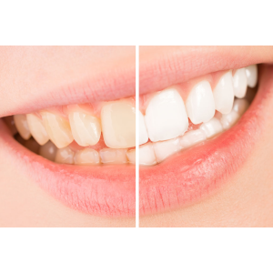 Tooth Whitening